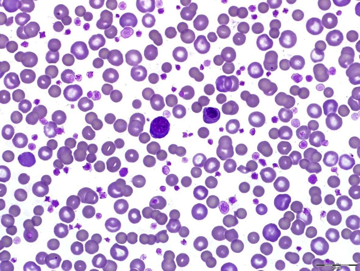 Clinical Image: What Are the 2 Darker-Staining Cells?