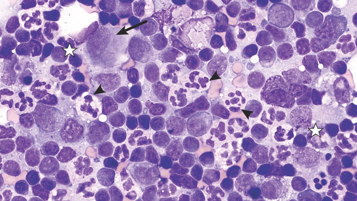 Clinical Image: Fine-Needle Aspirate