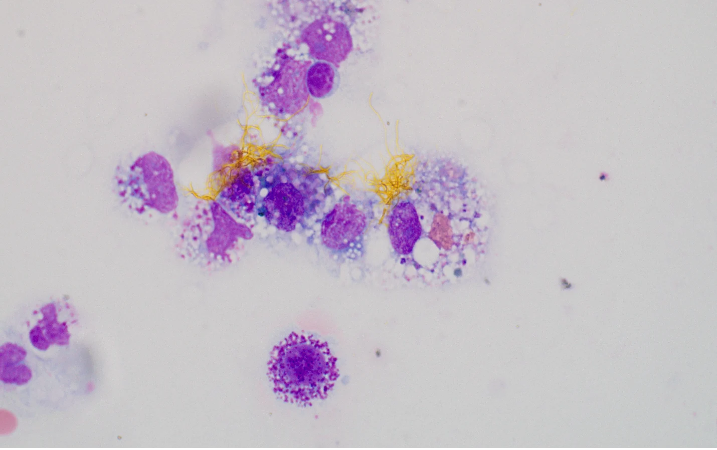 A microscopic image of an abdominal fluid sample shows bright orange crystals and macrophages.