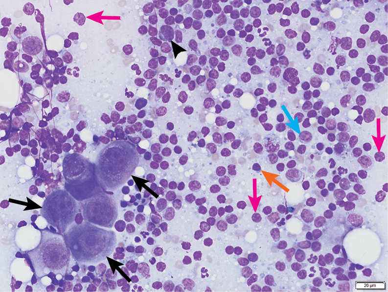 Top 5 Cytologic Findings in Aspirates of Enlarged Lymph Nodes ...