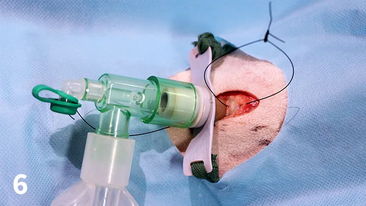 Surgically draped site of tracheostomy tube with tube in place illustrating suture placement for securing tube.