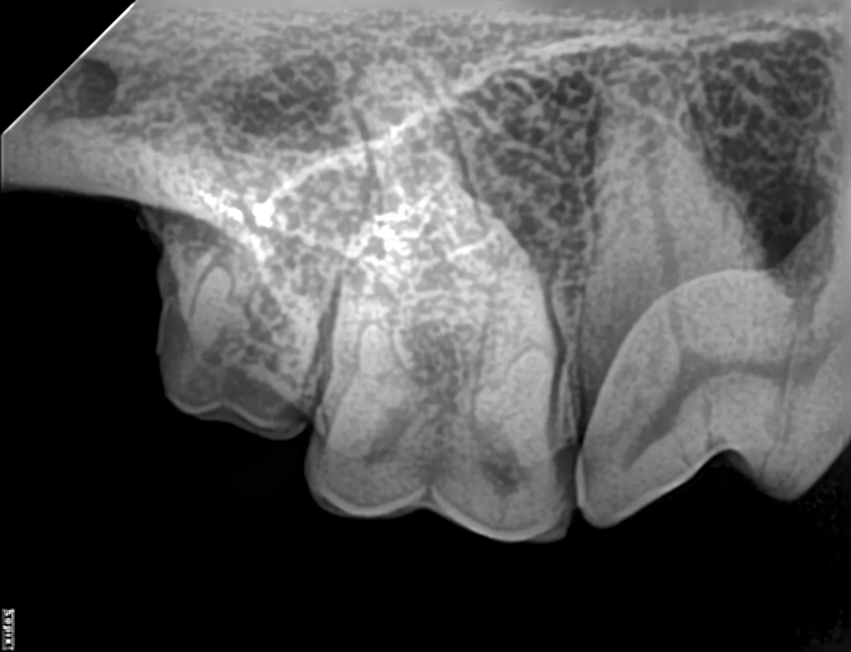 Intraoral radiograph of right maxillary molars using traditional positioning technique.