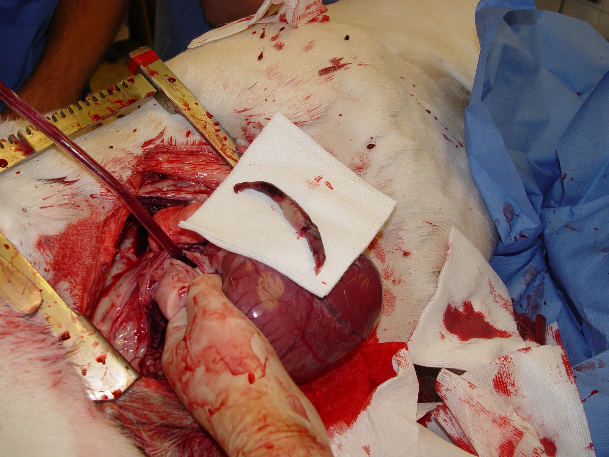 Intraoperative thoracic surgery image with large, long thrombus on gauze over exposed heart.