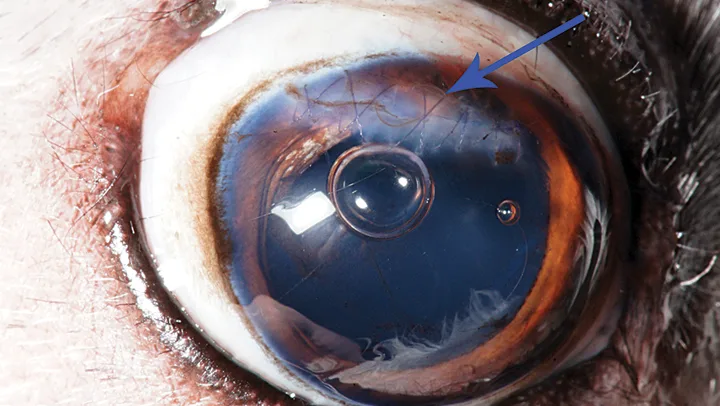 Eye with sutures over white streak running across dorsal cornea and two distinct bubbles in anterior chamber.
