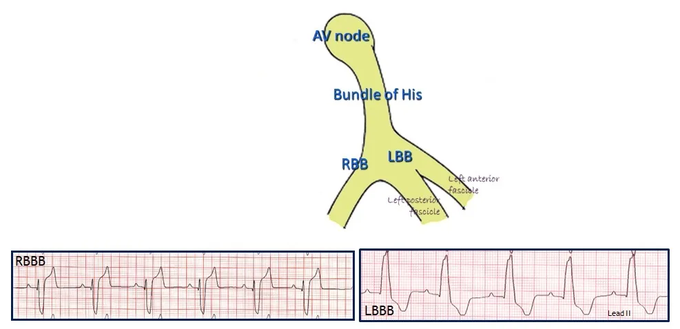 An illustration of the ventricular conduction system, and ECGs showing both right and left bundle branch blocks. 