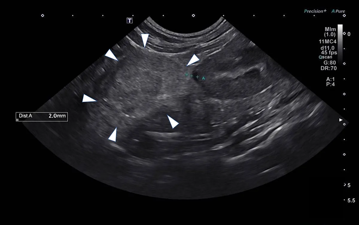 Abdominal ultrasound that has white arrowheads pointing to a mass.