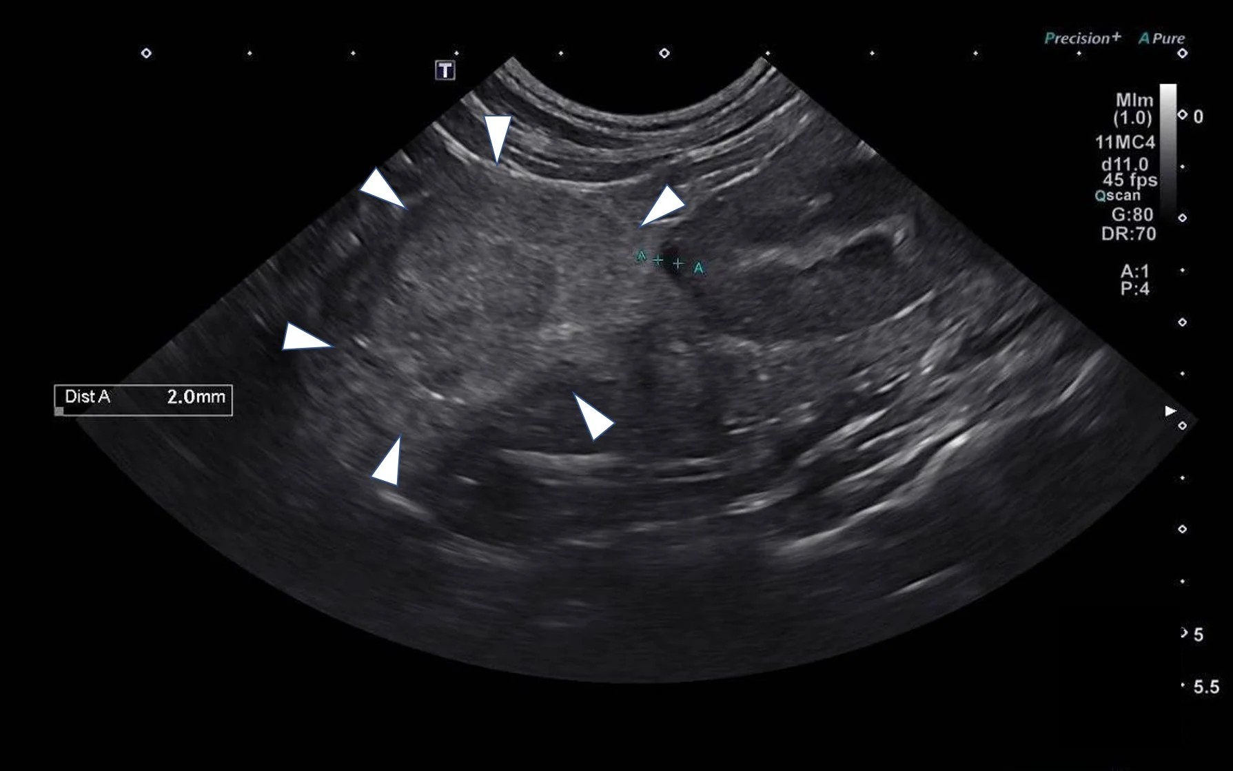 Abdominal ultrasound that has white arrowheads pointing to a mass.