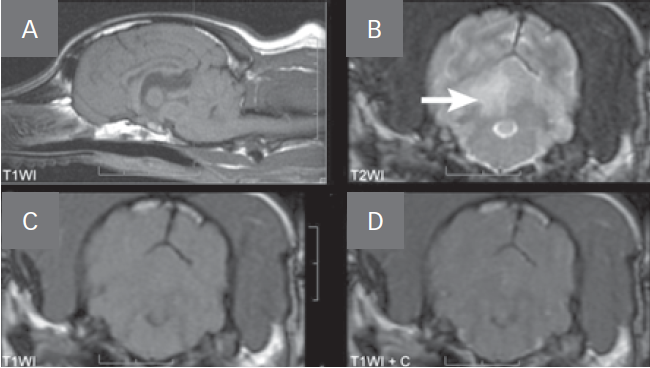 Cerebral Infarction | Clinician's Brief