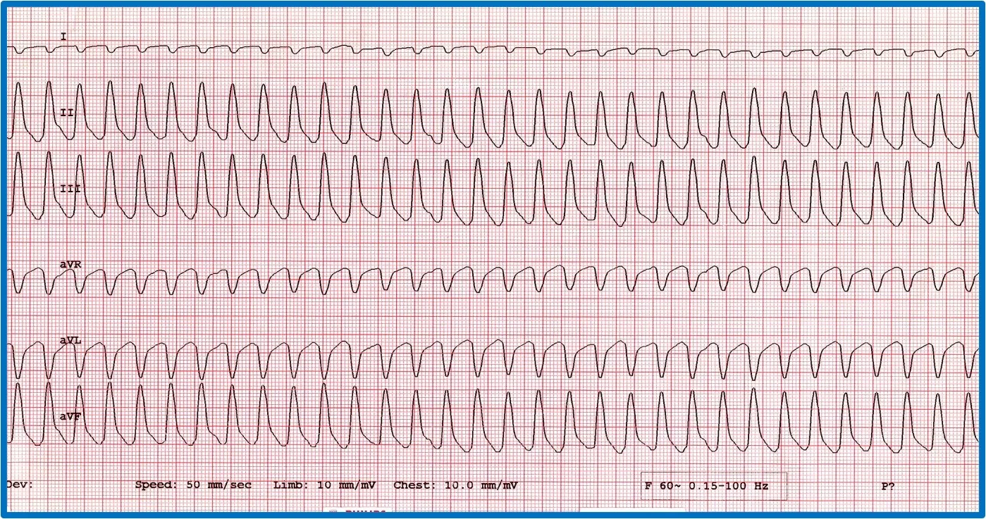 Figure 10A: A 6-lead ECG showing sustained tachycardia. Figure 10B: A 6-lead ECG showing an accelerated idioventricular rhythm and a circled fusion beat. 