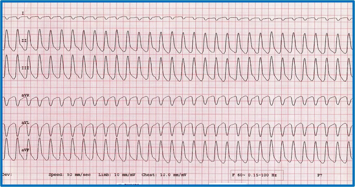 Figure 10A: A 6-lead ECG showing sustained tachycardia. Figure 10B: A 6-lead ECG showing an accelerated idioventricular rhythm and a circled fusion beat.