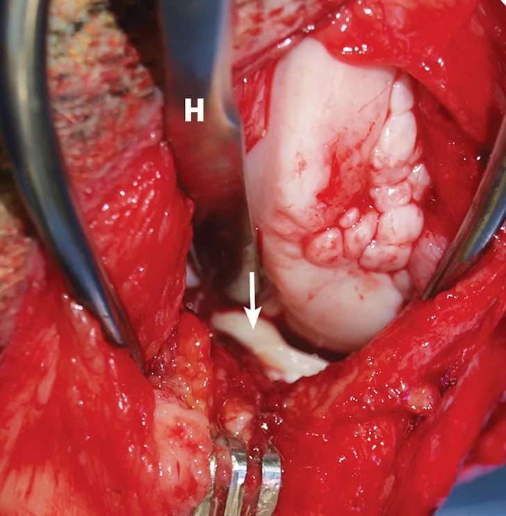 Intraoperative image with close-up of torn medial meniscus.