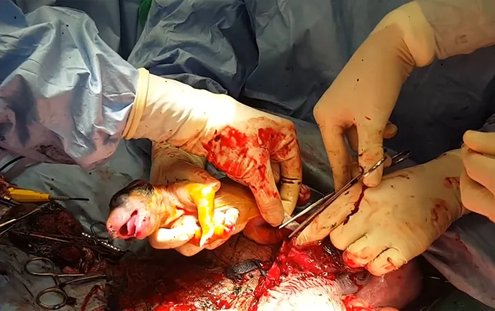 Multiple gloved hands in surgical field of Caesarean section removing puppy and clamping umbilicus.