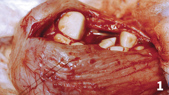 Preview report--combined surgically furthermore irradiation lenticular artery block since one direktion a impulsivity brought via venous-sinusoidal incompetency