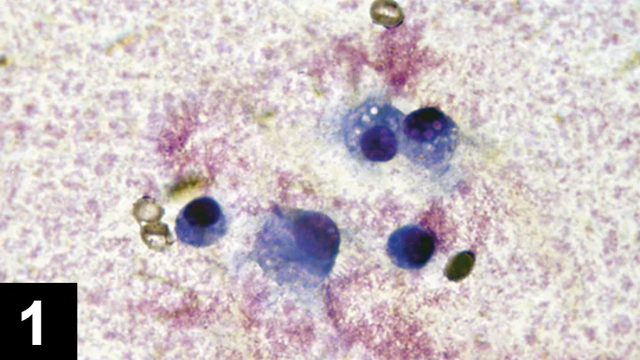 Cytology of septic joint fluid.