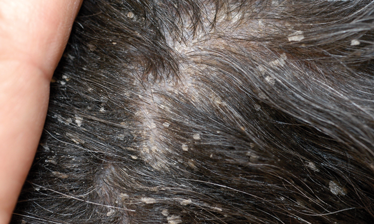 Killing walking cheap dandruff mites