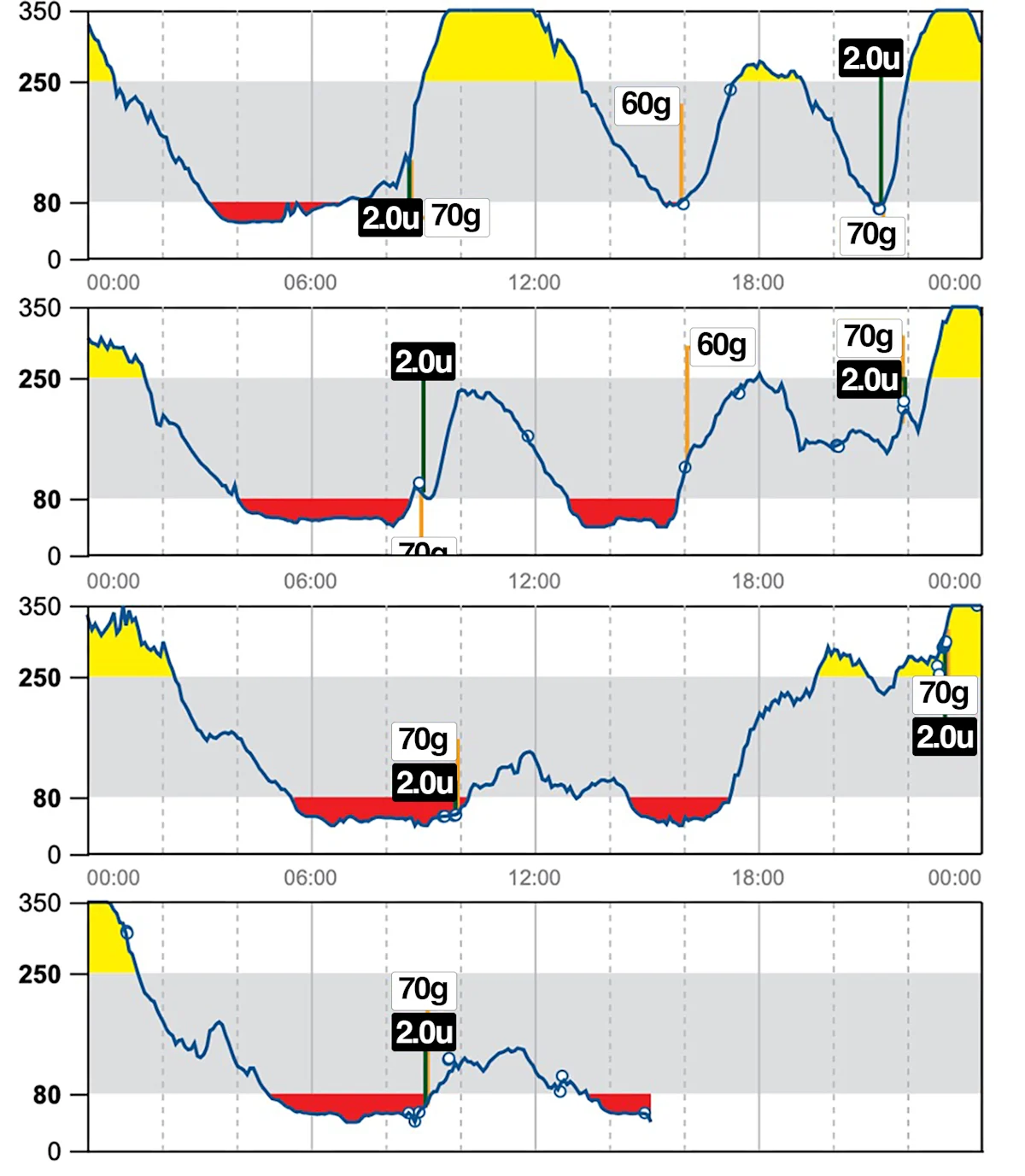 Four graphs from continuous blood glucose monitor readings illustrating improved glucose control with intraday variability.