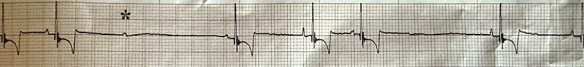 Underlying sinus rhythm and occasional second-degree AV block shown in this ECG.