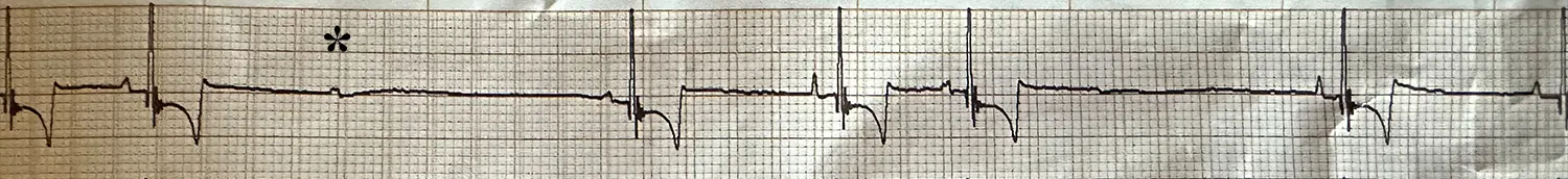 Underlying sinus rhythm and occasional second-degree AV block shown in this ECG.