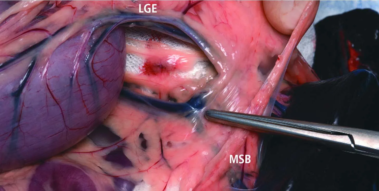 Forceps are pointed at a vessel junction.