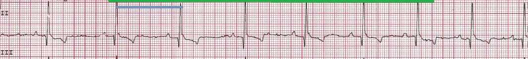 ECG tracing with short blue line denoting the R-R interval and longer green line denoting average rate.