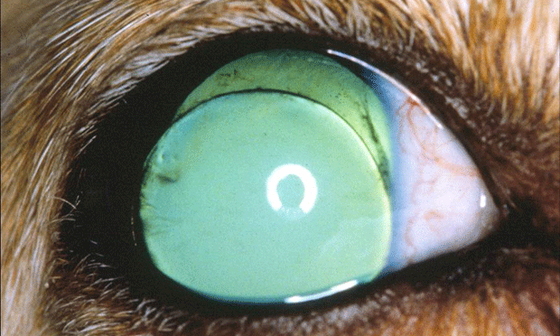 Acute Primary Angle Closure Glaucoma