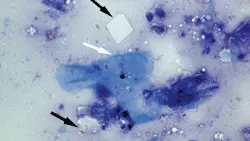 Stained cytology slide with arrows pointing to keratinocyte and two square-shaped clear objects.