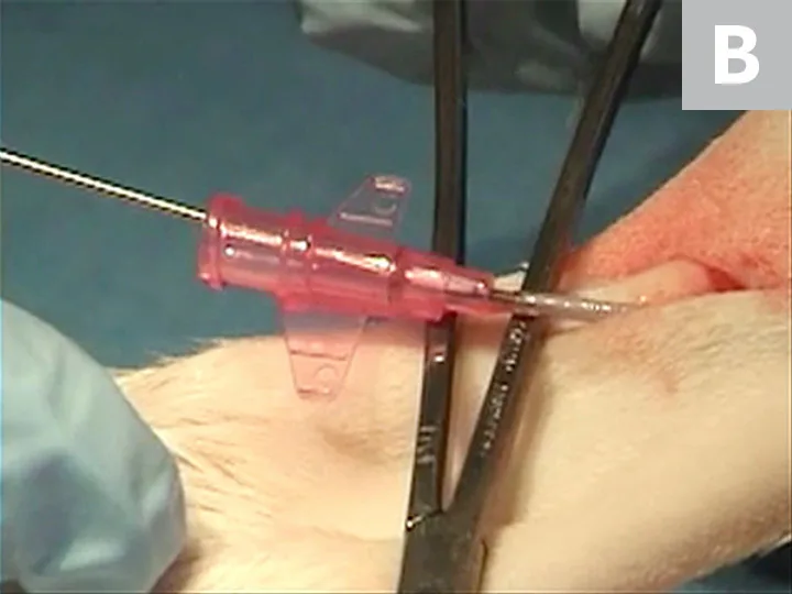 Two images showing insertion of catheter into saphenous vein and removal of the stylet.