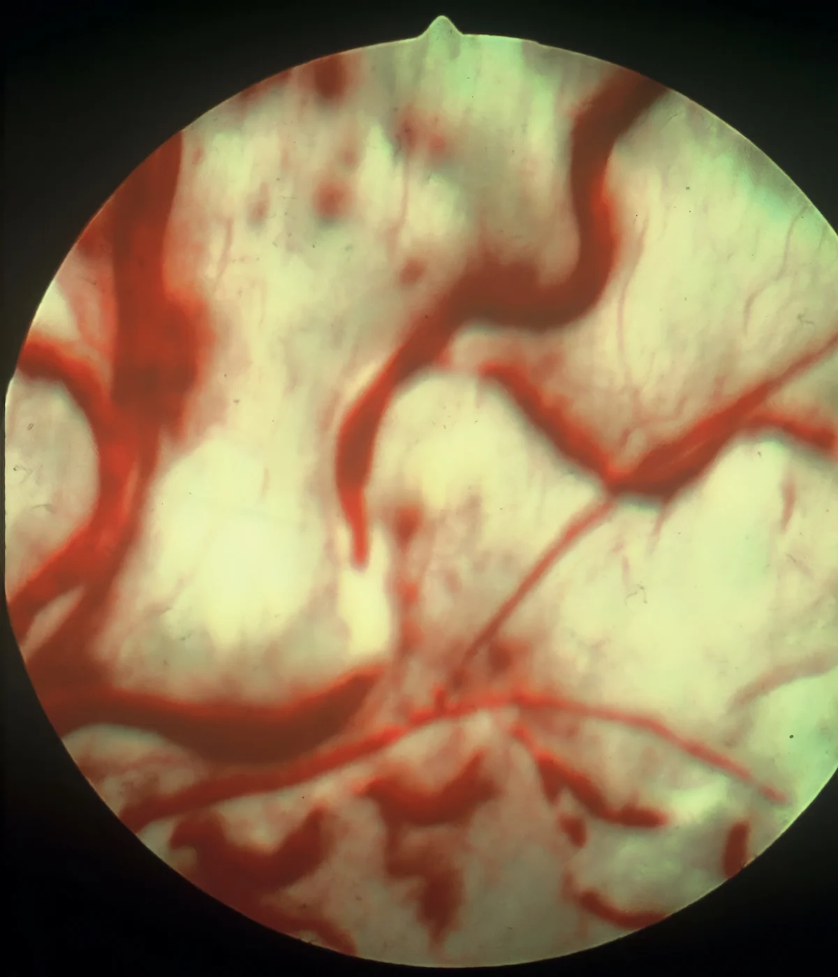 Retinal image with thick winding red vessels seen within bright yellow retina.