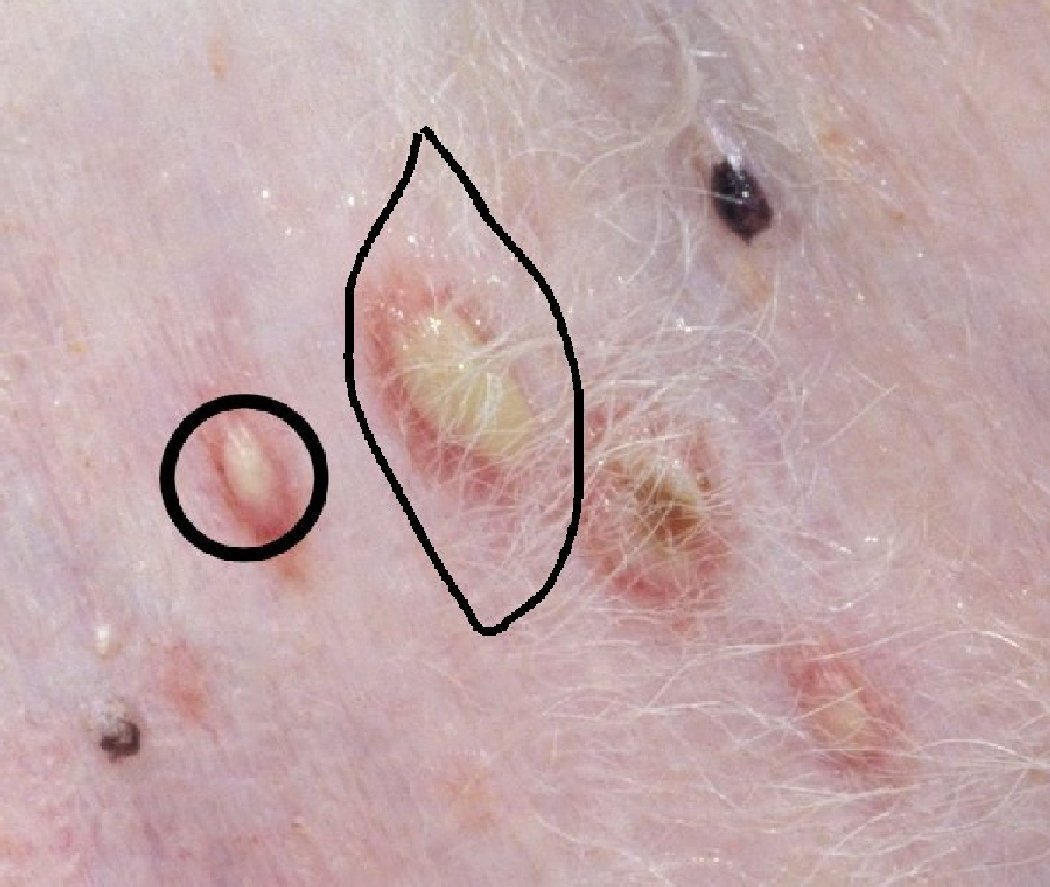 Scared Of Skin Biopsy
