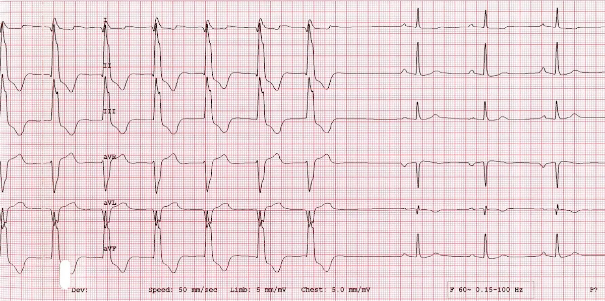 A 6-lead ECG with runs of ventricular ectopy.