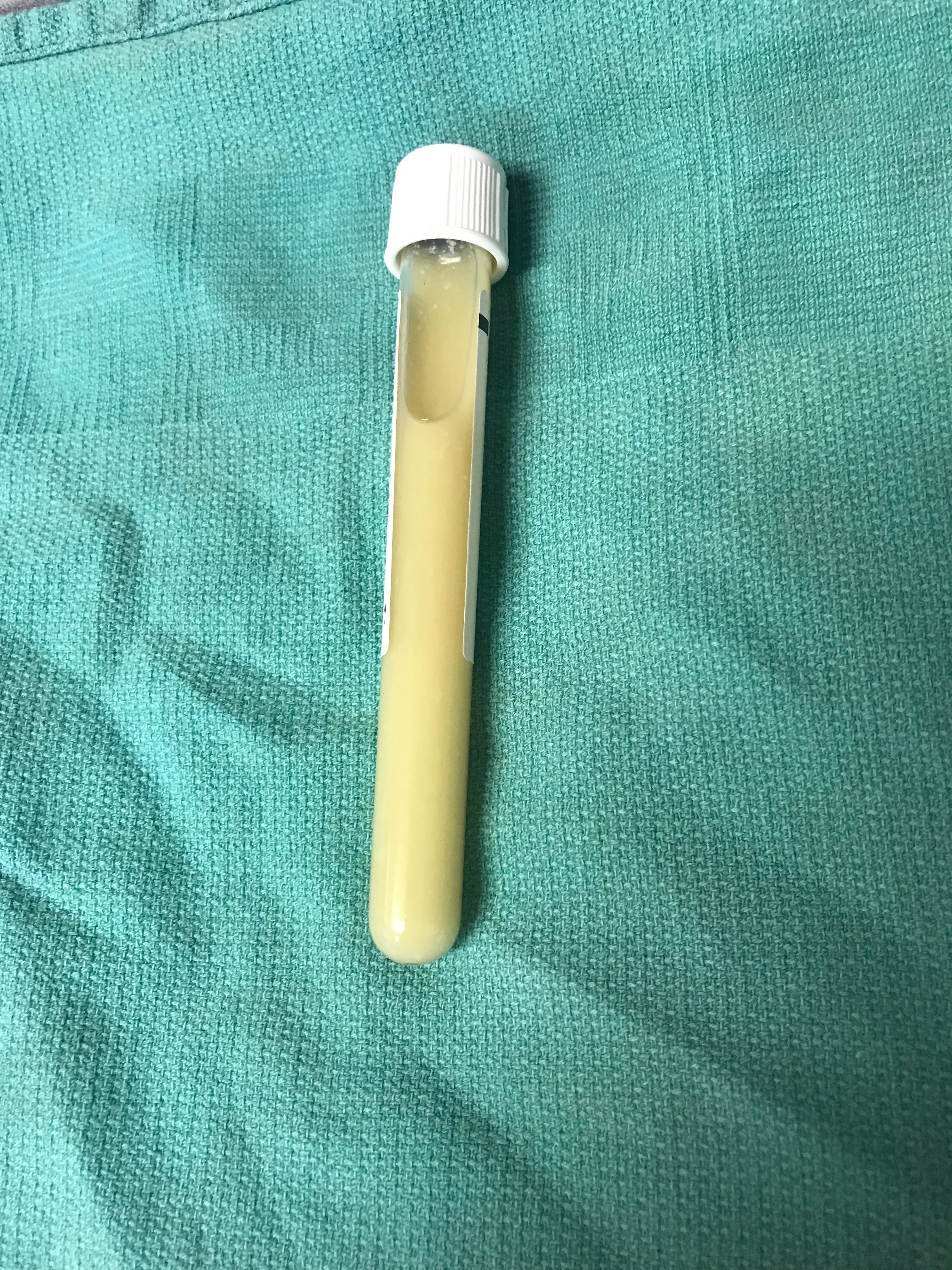 Glass vial with opaque yellow fluid lying on surgical drape.