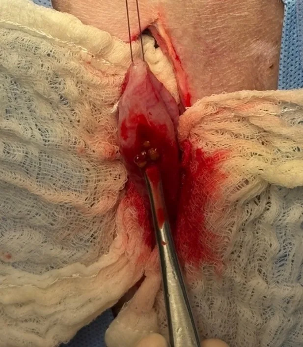 Incised bladder, with bladder spoon removing cystoliths from bladder.