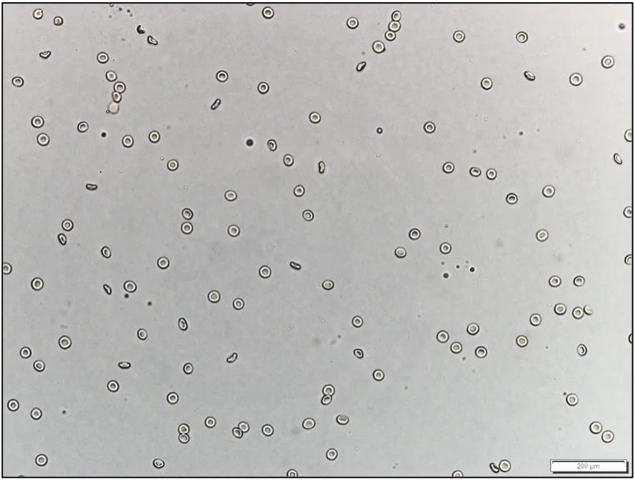 Two unstained urine sediment slides comparing how different urine volumes using the same sample can appear.