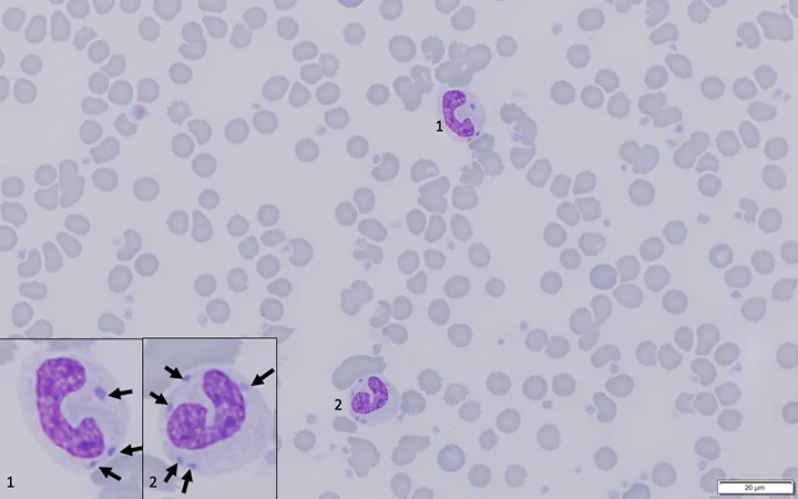 Blood smear showing numerous RBCs and 2 band neutrophils with inset showing details of the neutrophils.