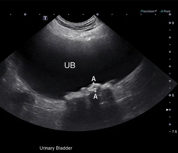 Ultrasound image of urinary bladder with markings denoting an irregular hyperechoic mass.