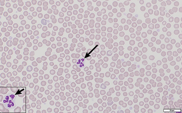 Botryoid Neutrophils & Inappropriate Rubricytosis in a Dog | Clinician ...