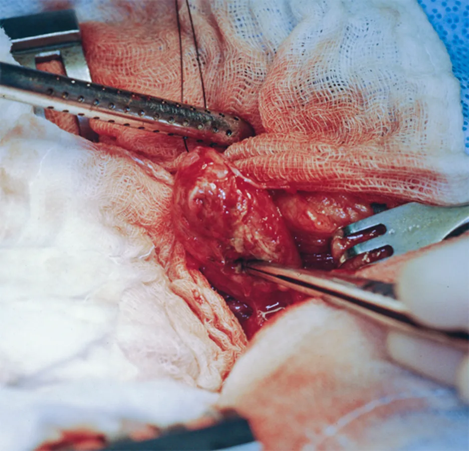 Exteriorized bladder with open defect in the suture line.