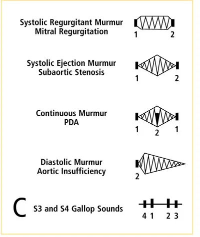 Phonocardiograms of heart murmurs and gallop sounds categorized by their timing in the cardiac cycle and illustrating the intensity and shape of conditions like mitral regurgitation and aortic insufficiency.