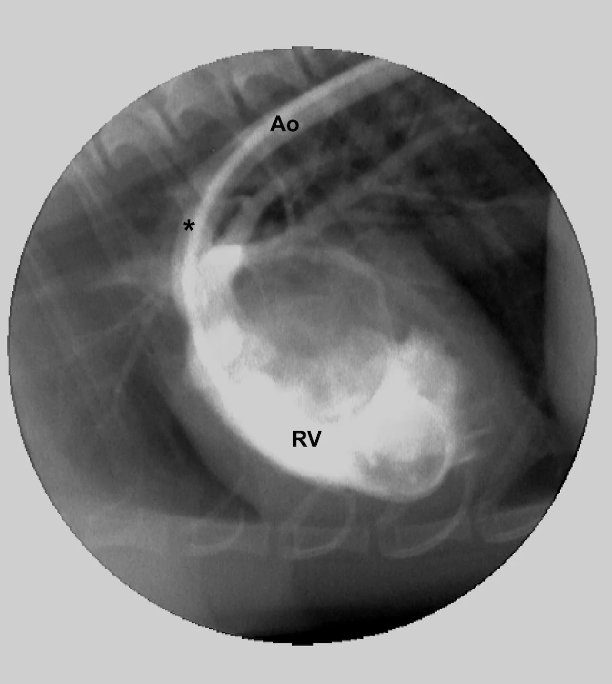 Lateral radiograph of a cat’s heart with a cardiac catheter in place and dye in the right ventricle marked RV. An asterisk marks a patent ductus arteriosus and an Ao indicates the distal aorta. 