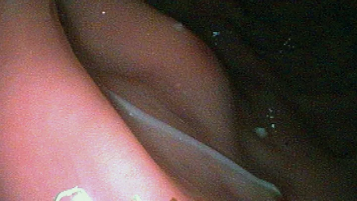 An endoscopic view of a white, wormlike object in the stomach of a patient.