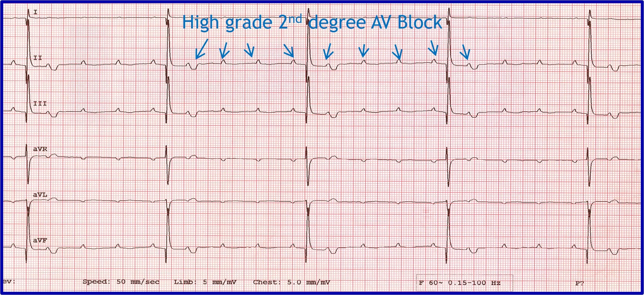 Figure 5A: A 6-lead ECG showing nonconductive P-waves. Figure 5B:  A post-atropine  6-lead ECG showing normal conduction of P-waves.