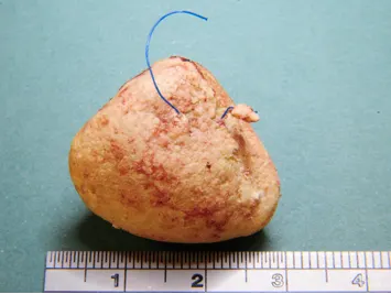 Single bladder stone with embedded suture material.
