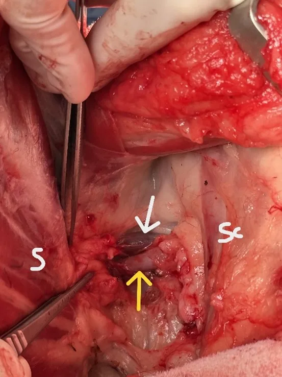 Close-up of exposed brachial plexus with muscles labeled and arrows pointing to axillary vein and artery.