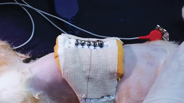 Split shot weights exposed on midline of external brace with attached sutures covered by bandages on either side.