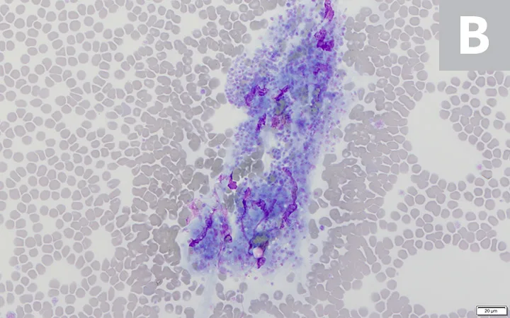 Figure 2A: A microscopic image of a blood smear showing clumped platelets. Figure 2B: A zoomed-in microscopic image of a blood smear showing clumped platelets.
