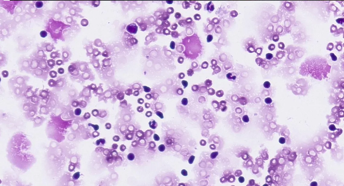 Cytology of pleural effusion showing numerous purple-staining cells.