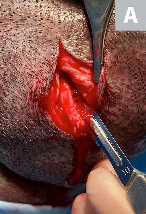 Two images showing how to incise through a tumor to collect a biopsy specimen.