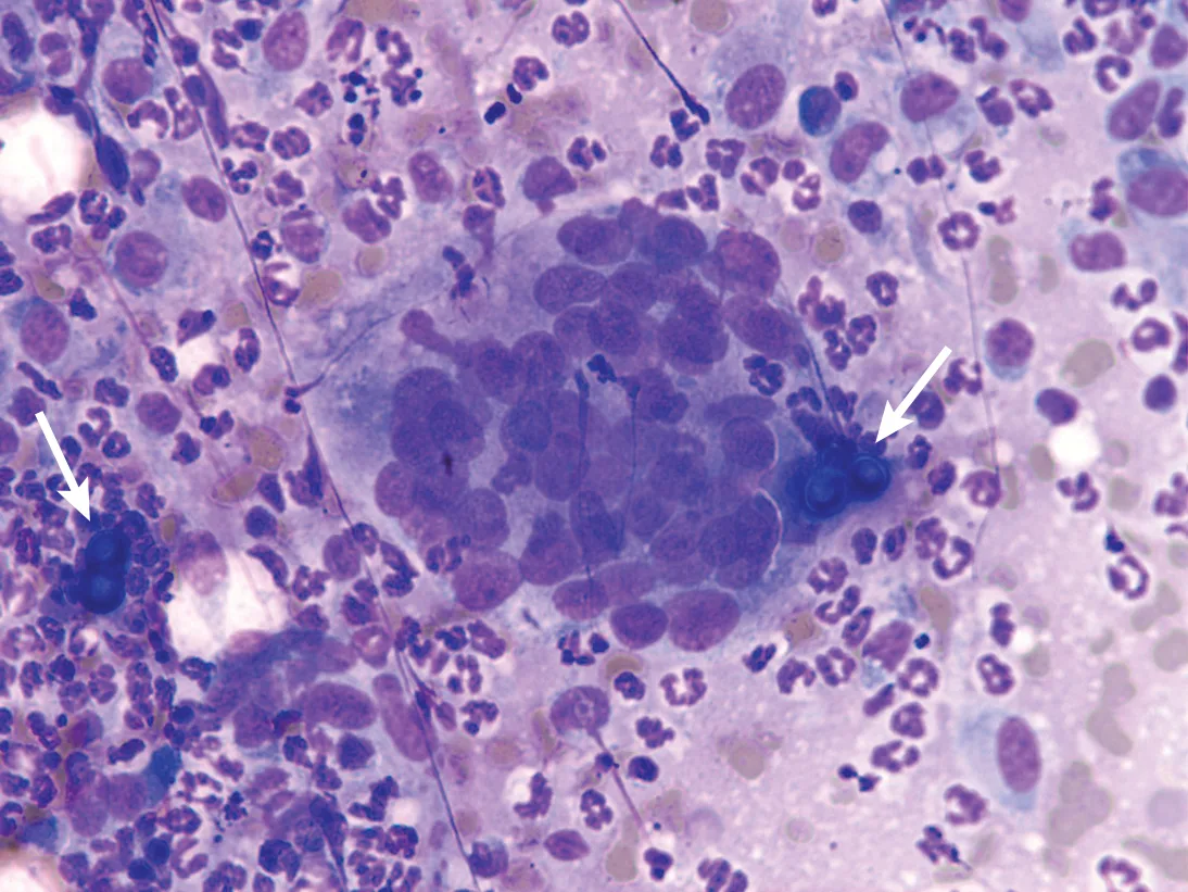 A microscopic image of a lymph node aspirate.