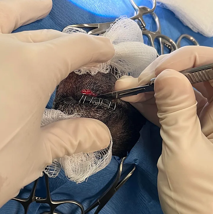 Surgeon incising near eyelid margin of dog and appearance of eye after circumferential incision is complete.