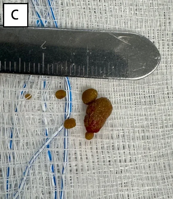 Several calculi of varying sizes after removal from bladder.